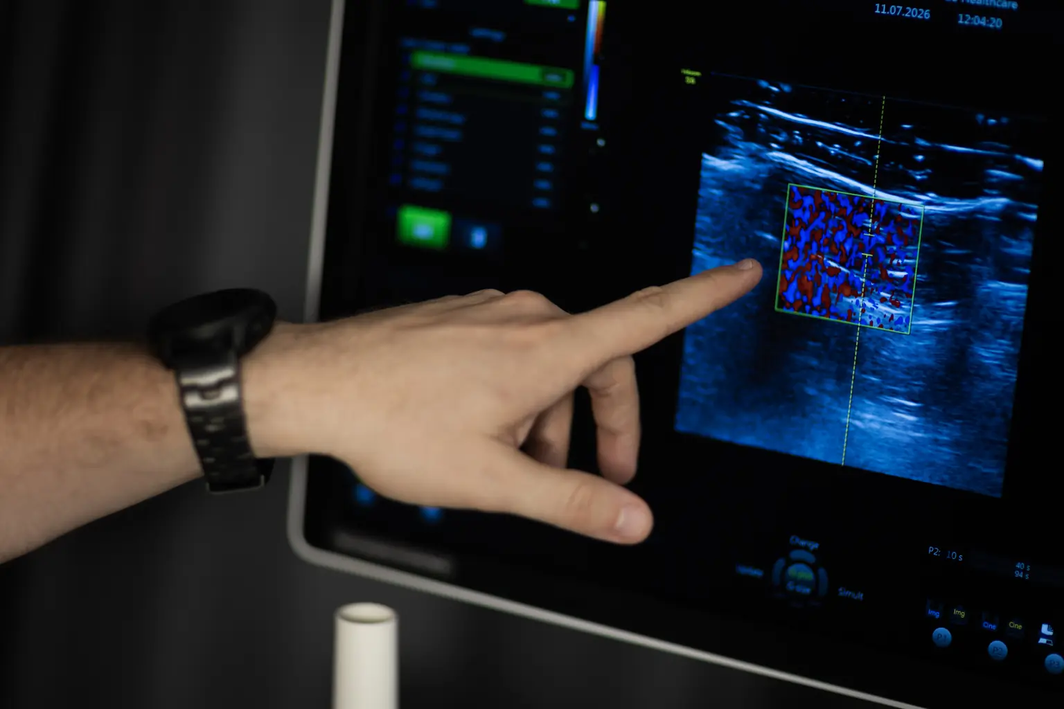 USG Doppler żył kończyn dolnych podczas diagnostyki flebologicznej